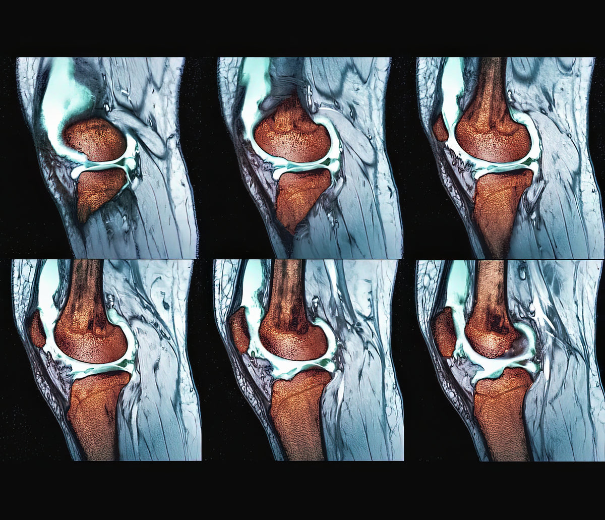 Real Sprained Knee Pictures Art Print | Museum-Quality Medical Illustration | RedKalion