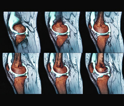 Real Sprained Knee Pictures Art Print | Museum-Quality Medical Illustration | RedKalion