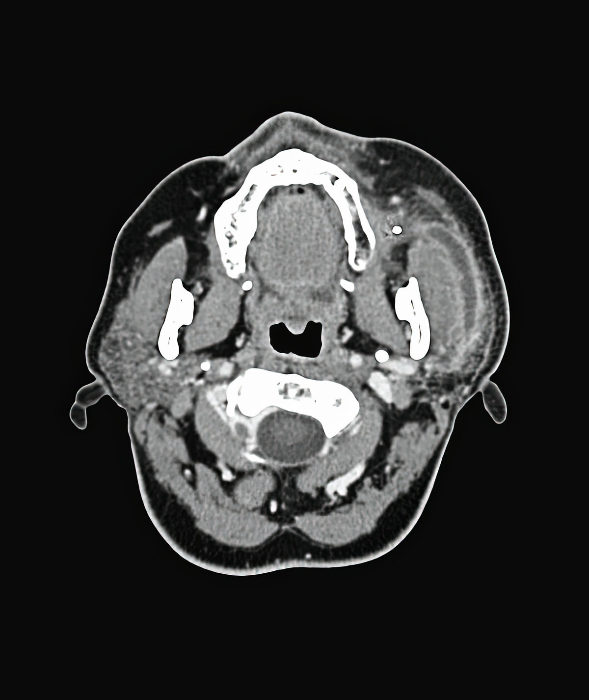 Salivary Gland Stone Pictures: Medical Art Print | RedKalion