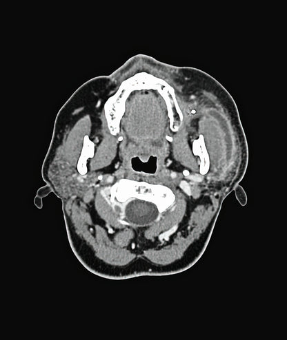 Salivary Gland Stone Pictures: Medical Art Print | RedKalion