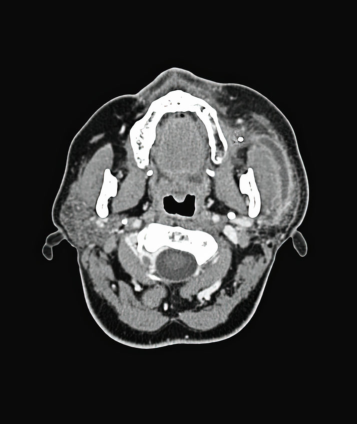 Salivary Gland Stone Pictures: Medical Art Print | RedKalion