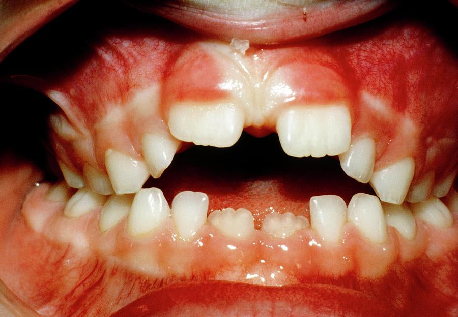 Teeth from Sucking Fingers Art Print | Medical Illustration | RedKalion